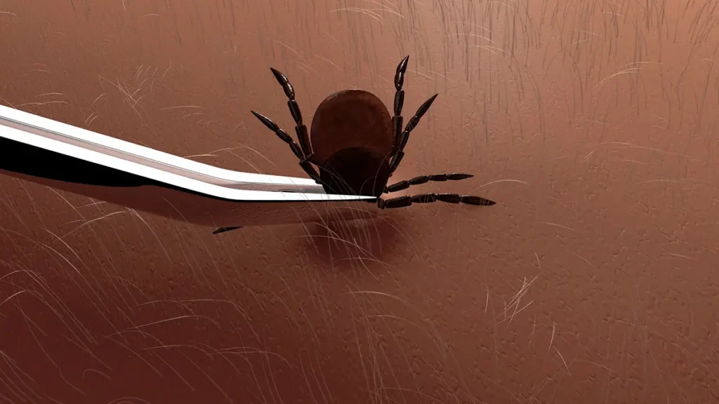 How to remove a tick with tweezers