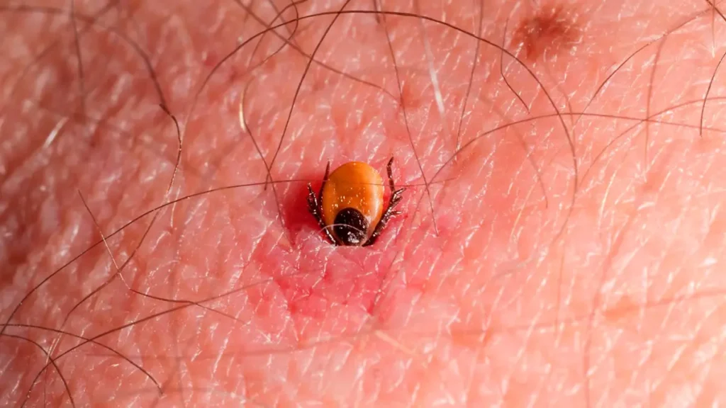 How to remove a tick on a human